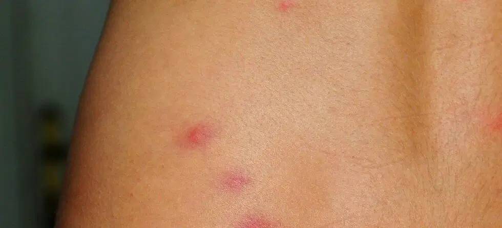 picaduras chinches