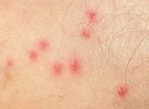 ¿Por Qué las Chinches no Pican a Todos?